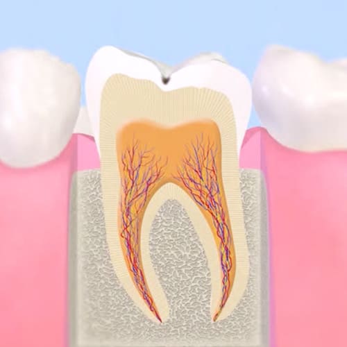初期のむし歯（CO）