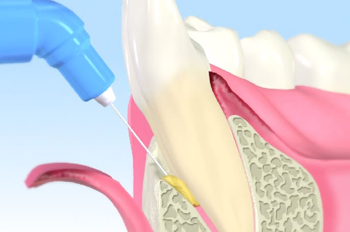 歯周組織再生療法「エムドゲイン」