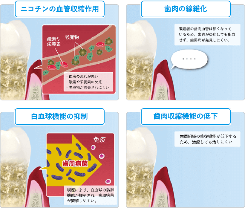 歯周病とタバコの関係