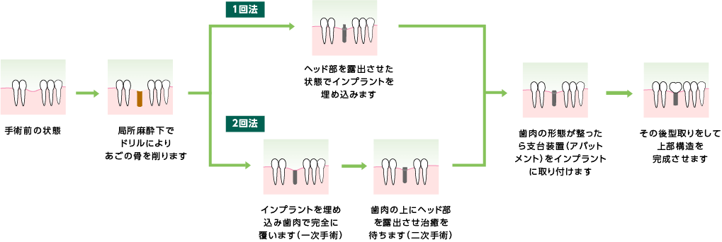 インプラント2回法