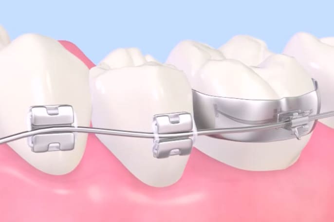 ブラケットによる部分矯正